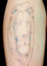 Odstraňování tetování laserem - po 3 ošetřeních