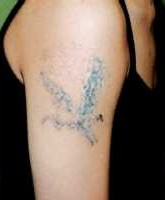 Odstraňování tetování laserem - po 3 ošetřeních