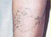 Odstraňování tetování laserem - po 2 ošetřeních