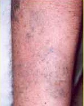 Odstraňování tetování laserem - po 7 ošetřeních rubínovým laserem