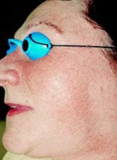 Odstranění žilek v obličeji, pavoučky - za měsíc po výkonu cévním KTP laserem