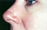 Odstranění žilek v obličeji, pavoučky - za měsíc po výkonu cévním KTP laserem