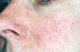 Odstranění žilek v obličeji, pavoučky - cévky kolem nosu a tváří