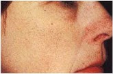 Odstranění žilek v obličeji, pavoučky - po 2 ošetřeních cévním KTP laserem
