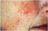 Odstranění žilek v obličeji, pavoučky - výrazné cévky tváří