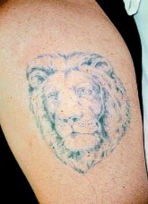 Odstraňování tetování laserem - před zákroky